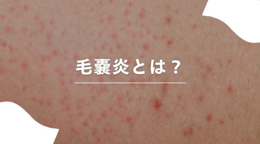 脱毛　毛嚢炎