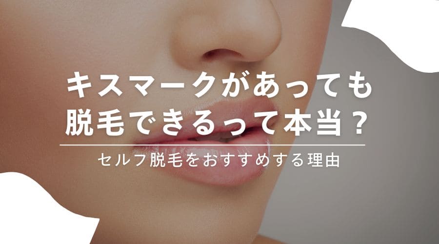 キスマークがあっても脱毛できるって本当？セルフ脱毛をおすすめする理由