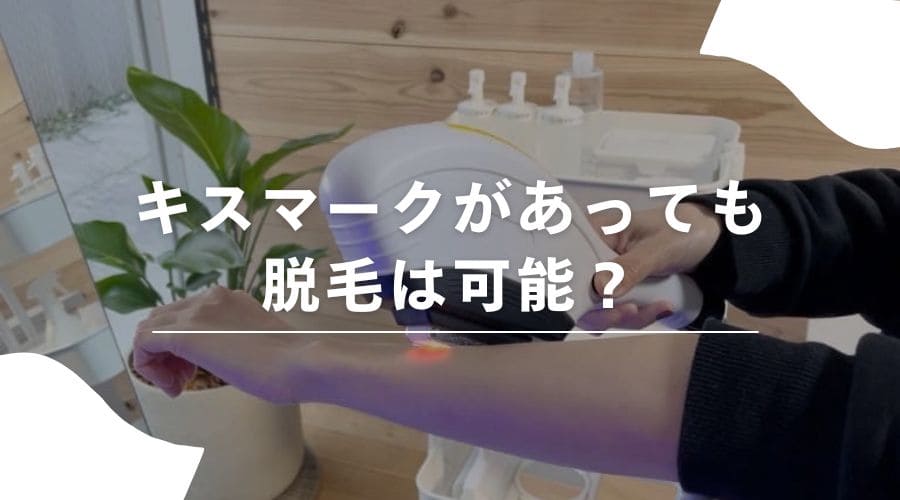 脱毛　キスマーク